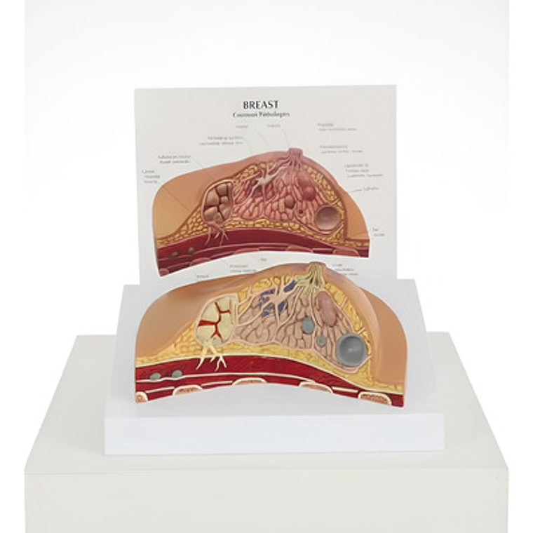 Modelo Anatómico De Mama Con Patologías Mas Comunes Completo 4