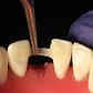 Banda De Refuerzo Dental Tira De Fibra Tipo Ribbond Calidad - Miniatura 2