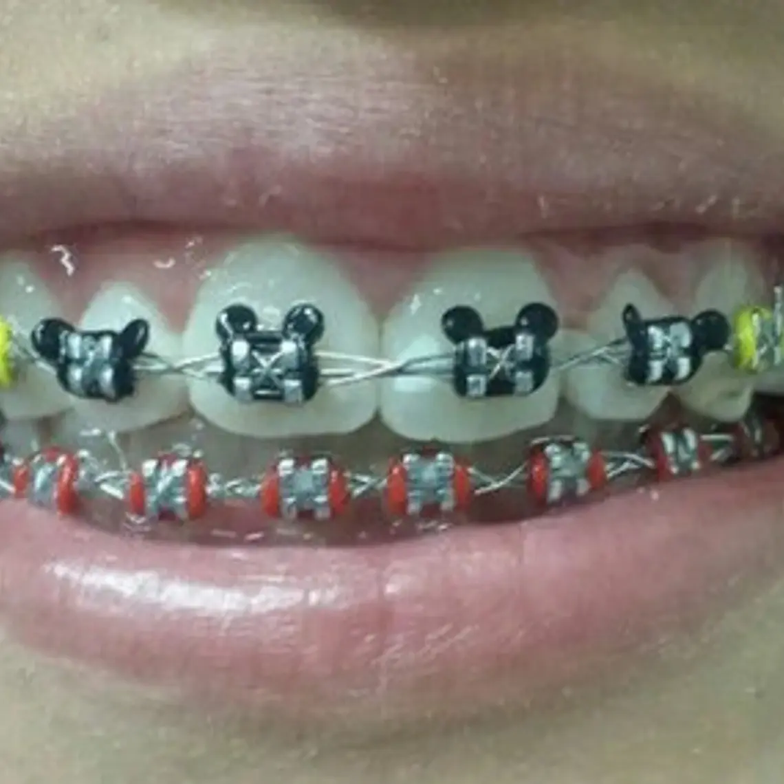 Ligaduras Ortodoncia De Mickey Mouse Colores 1000u Santiago 4