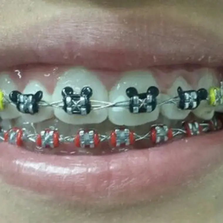 Ligaduras Ortodoncia De Mickey Mouse Colores 1000u Santiago 4