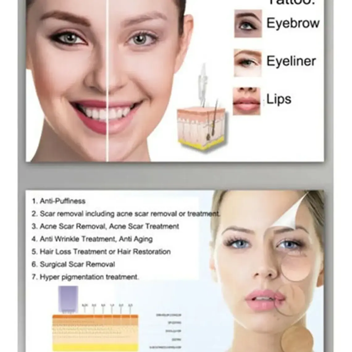 Cartuchos Micro Agujas Dermapen Modelos Simportas Santiago 13