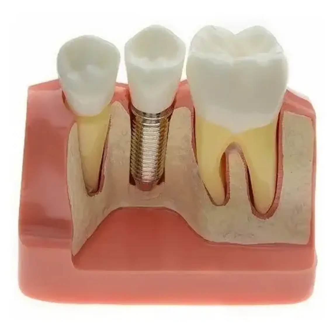 Modelo Dental Enseñanza Y Estudio Puente Gigante Santiago 1