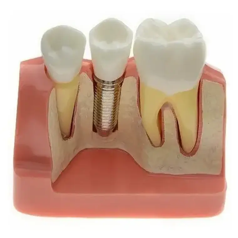 Modelo Dental Enseñanza Y Estudio Puente Gigante Santiago 1