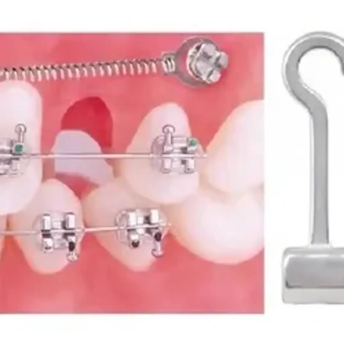 Crimpables Hook Ortodoncia Bolsita 10u Santiago 11