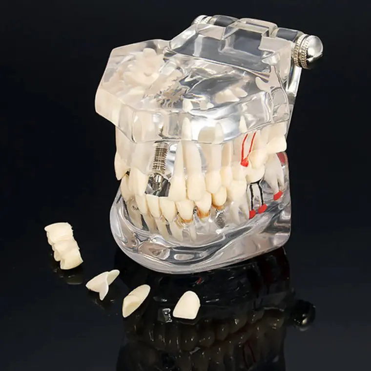 Modelo Dental Enseñanza Y Tratamientos Implantes Protesis 6