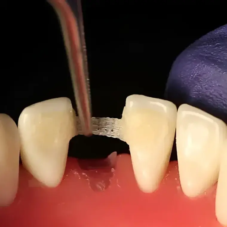 Banda De Refuerzo Dental Tira De Fibra Tipo Ribbon 1 Rollo 9