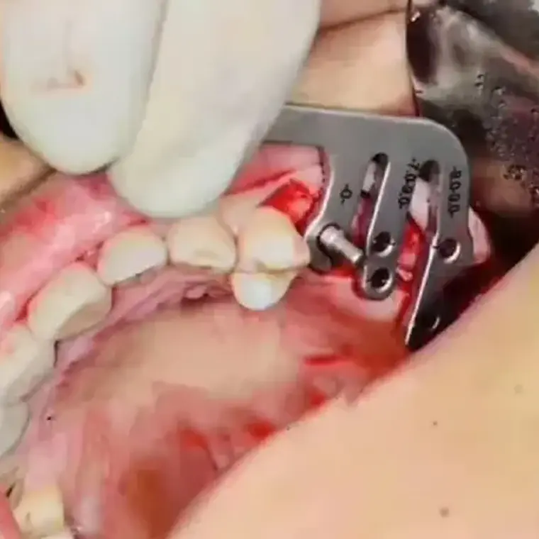 Reglas De Medición Para Implantes Dentales Guía Set Santiago 4