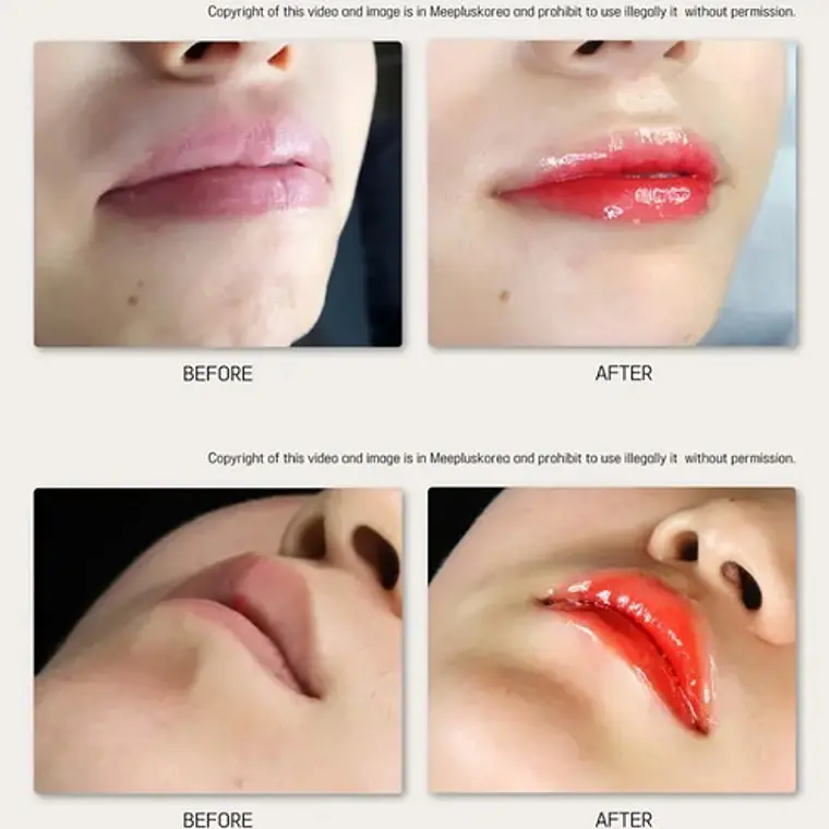 Bb Lips Serum Dr Lan Frost Set Completo 5 Ampollas Santiago 6