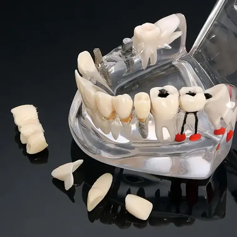 Modelo Dental Enseñanza Y Tratamientos Implantes Protesis 5