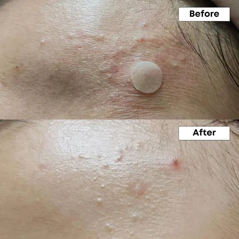 Serum Acne Control 10% Azelaic acid -30 ml