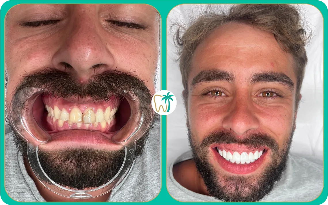 Resultados estéticos de carillas dentales en Miami