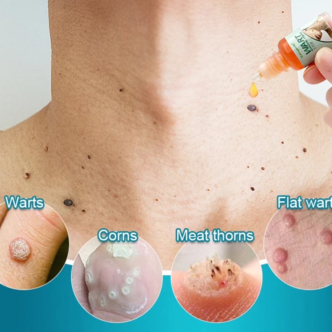 ✨ Ungüento Eliminador de Verrugas y Condilomas – Alivio y Acción Rápida ✨ 3