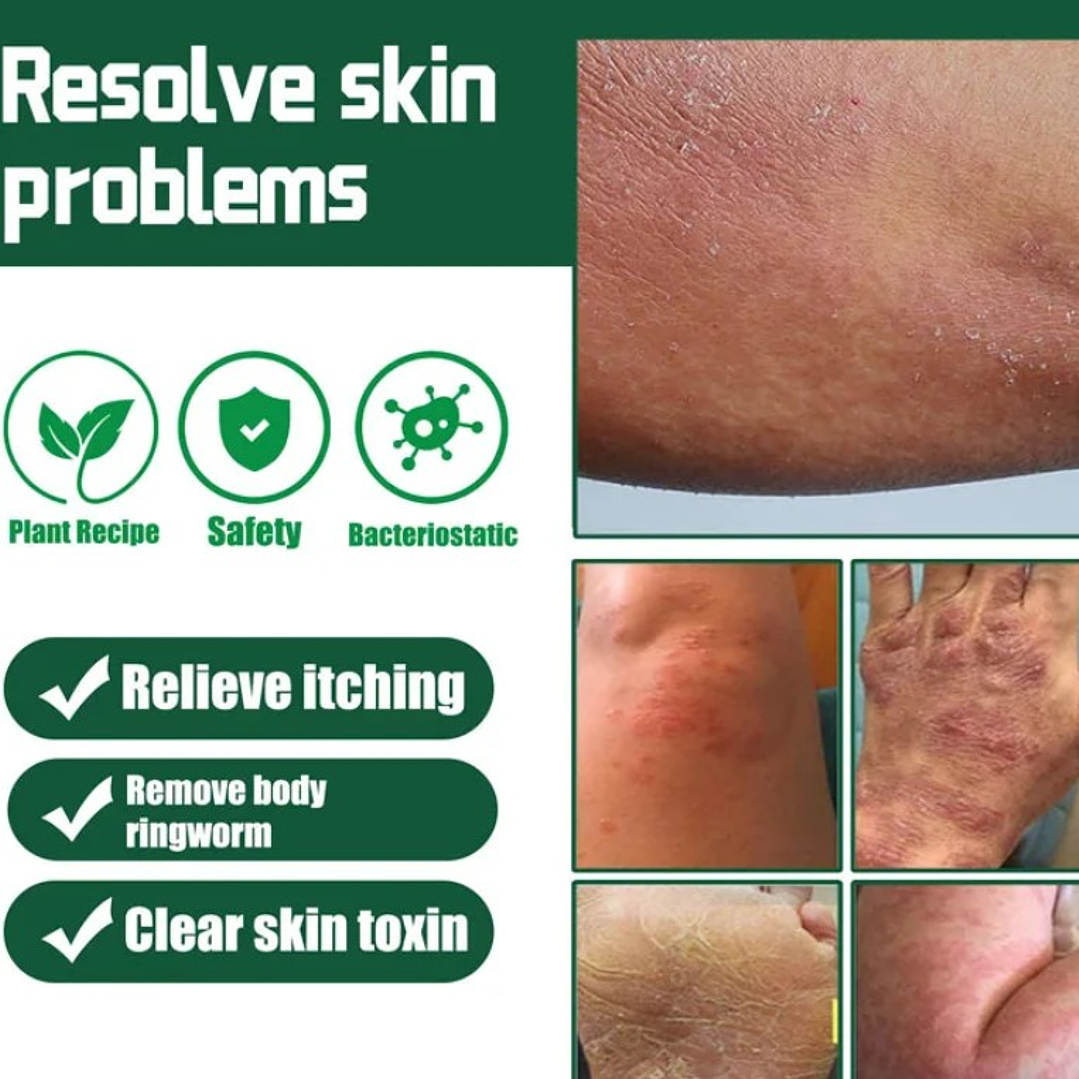 🌱 Crema Herbal para Psoriasis, Dermatitis y Eczema – Antibacteriana y Antipicazón🌱 4