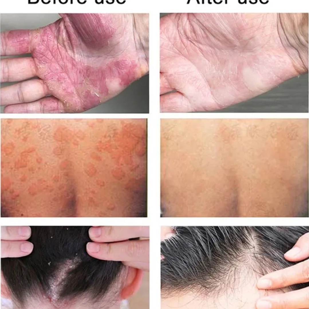 🌱 Crema Herbal para Psoriasis, Dermatitis y Eczema – Antibacteriana y Antipicazón🌱 7