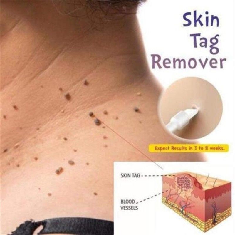 Solución South Moon para Skin Tags y Verrugas con Extractos Naturales – Uso Tópico (30 ml) 4