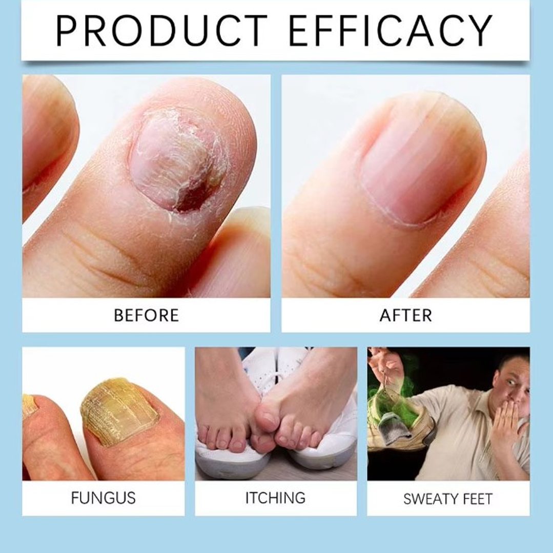 ✨💅Gel con Solución Anti Micosis Antihongos – 30 ml + Lima de Uñas💅﻿✨ 6