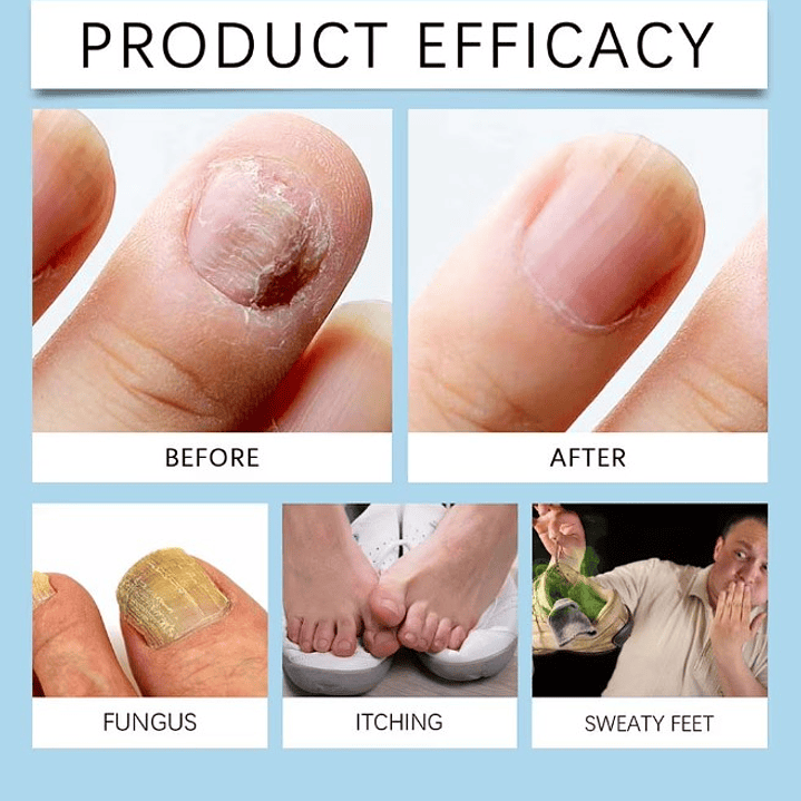 ✨💅Gel con Solución Anti Micosis Antihongos – 30 ml + Lima de Uñas💅﻿✨ 6