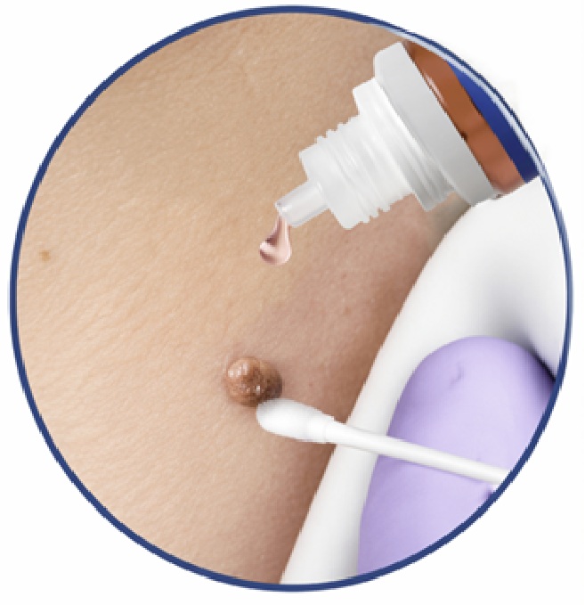 Serum para Verrugas y Skin Tags HOLJKEA – Extractos Naturales 20 ml 2