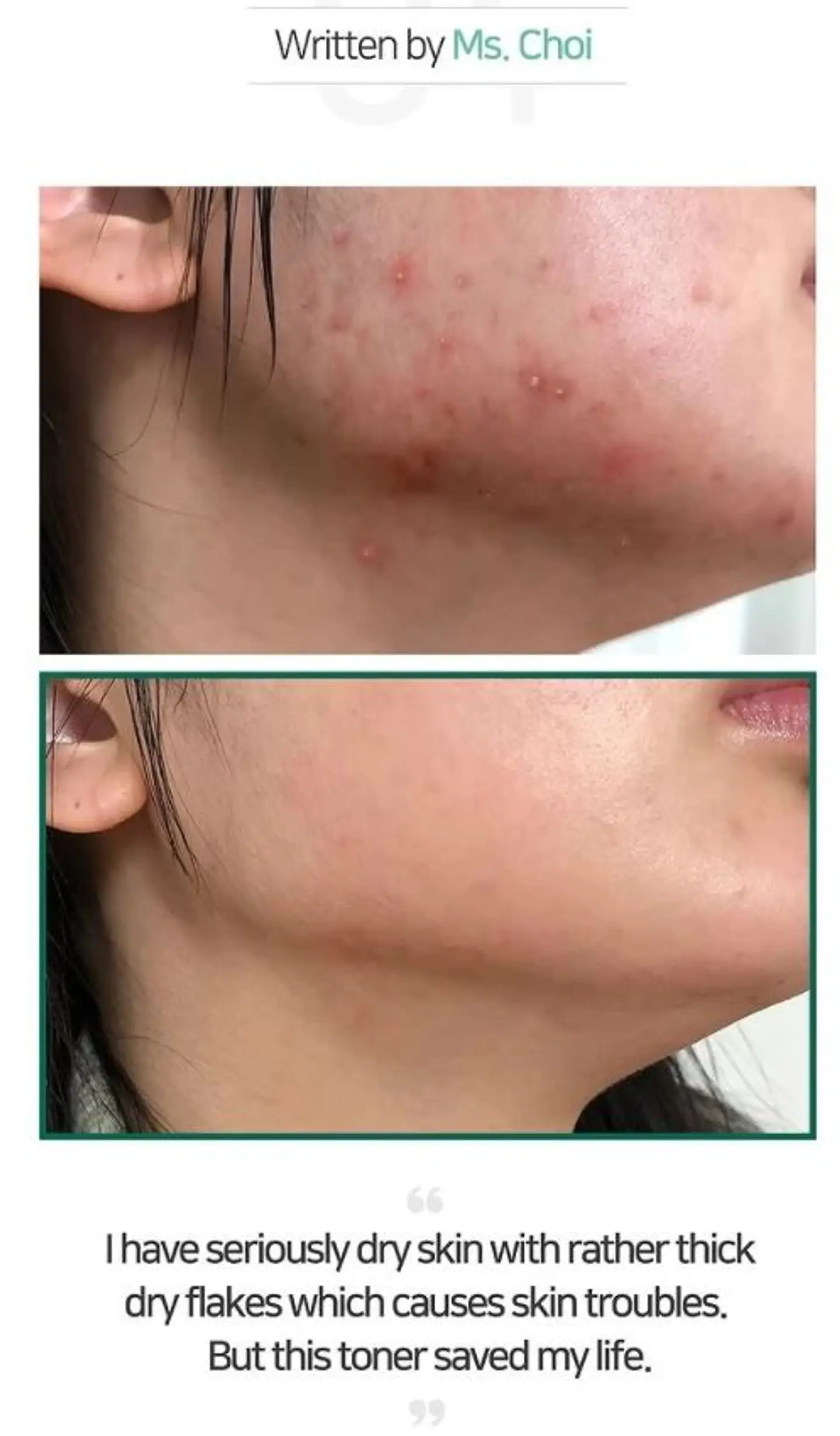 AHA BHA PHA 30 Days Miracle Toner (Some By Mi) - 150ml Tónico para pieles con problemas 5