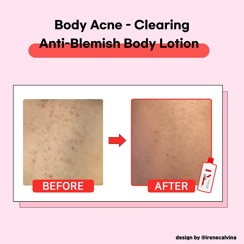 Blemish Body Lotion (TIAM) -200ml Crema corporal anti acné y grasitud 5