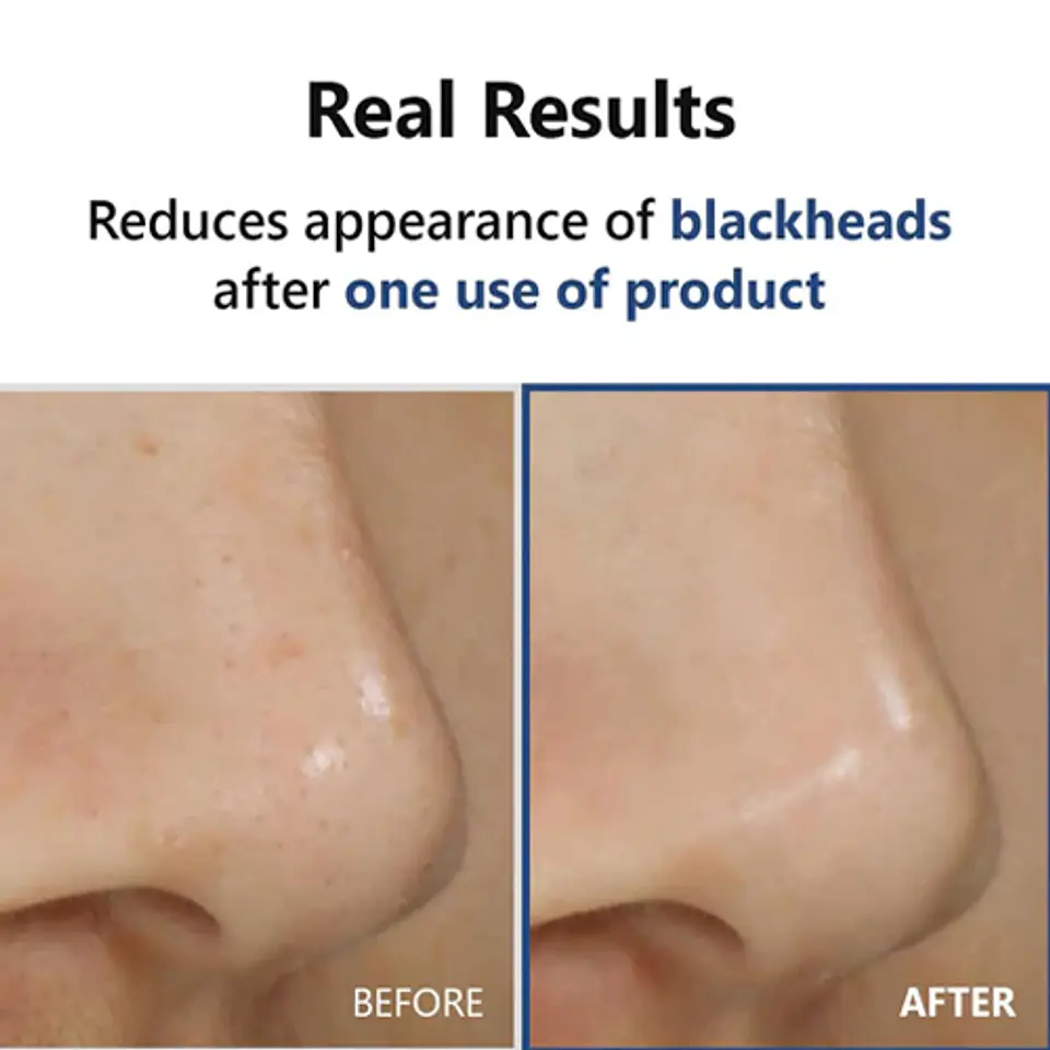 Hyper Acid 4 AHA BHA PHA LHA Serum (Isntree) - 20 ml Serum exfoliante químico 4 tipos de ácidos pieles problemáticas 8