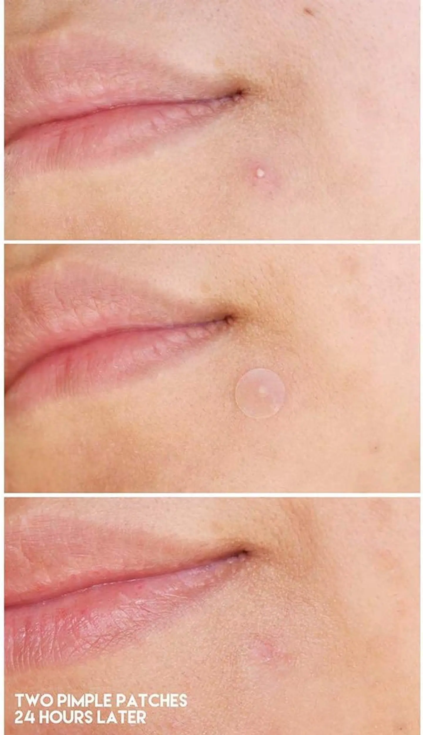 Acne Pimple Master Patch (COSRX) - Sobres con 24 parches hidrocoloides para espinillas 17