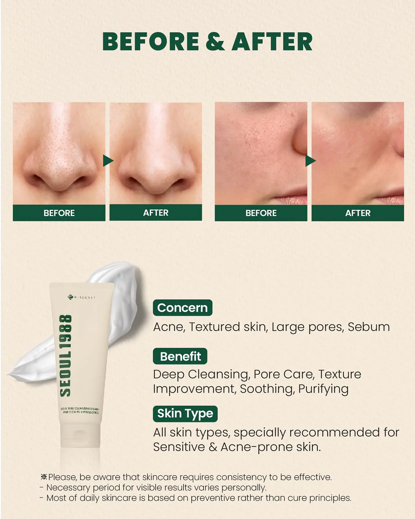 Seoul 1988 Cleansing Foam: Pine Cica 1% + Probiotics (K-Secret) - Limpiador en espuma  pieles mixtas grasas 3