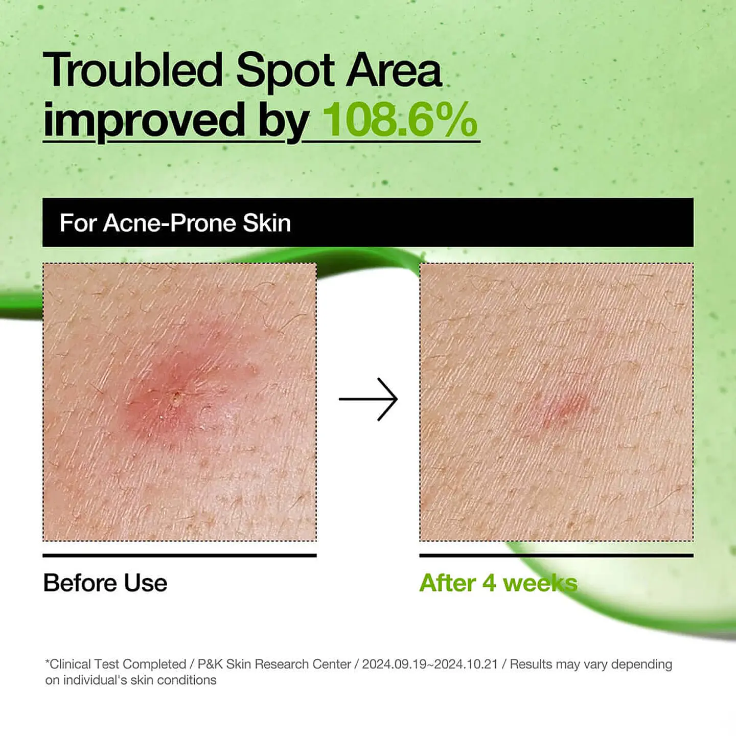 Azelaic Acid 10 Hyaluron Redness Soothing Serum (ANUA) - 30ml  8