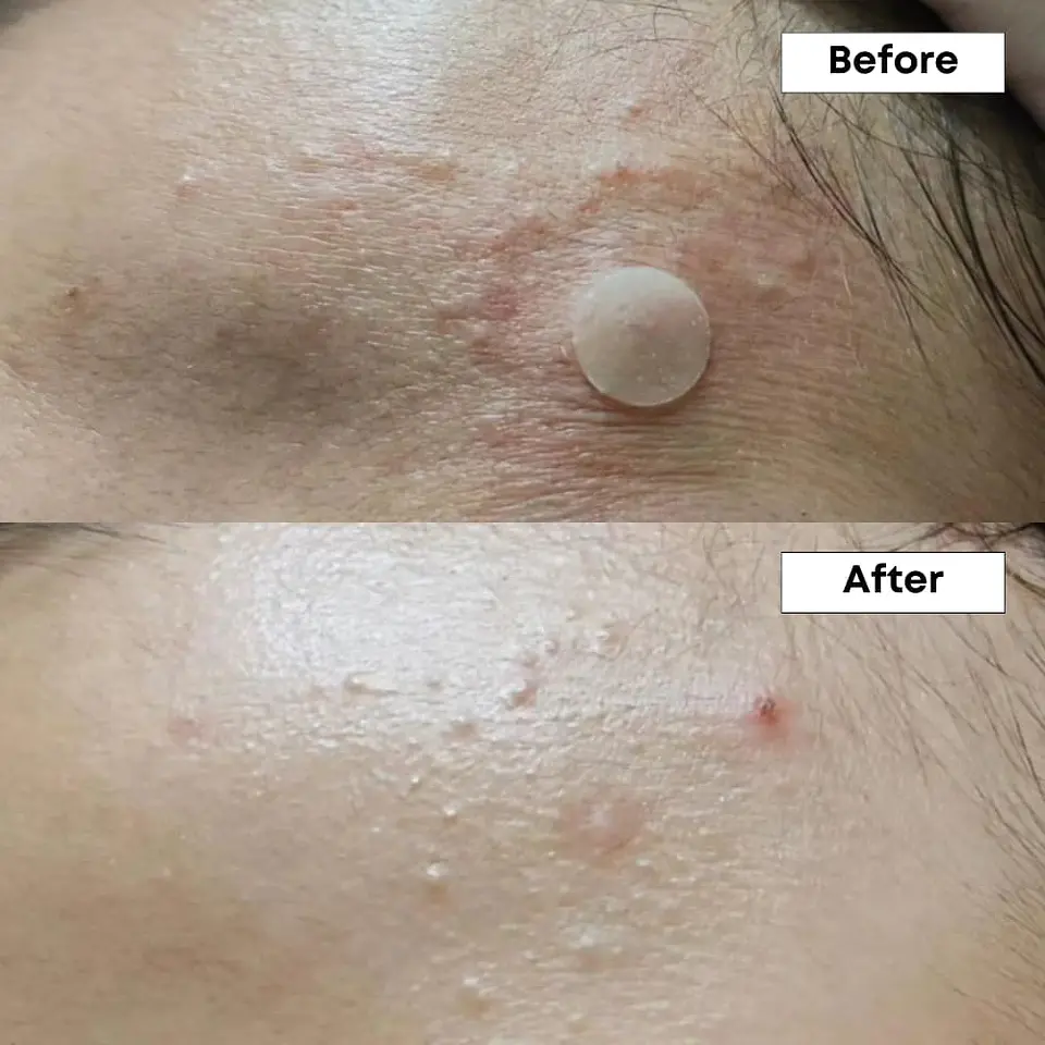A-Control 10% Azelaic Acid Serum 30ml  (Nineless) - 30ml Serum 10% ácido azelaico anti imperfecciones 7