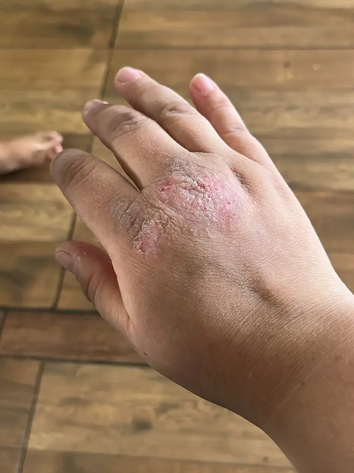 Dermatitis de contacto 2