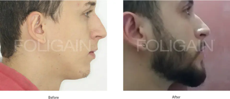 MINOXIDIL 5% FOLIGAIN 4