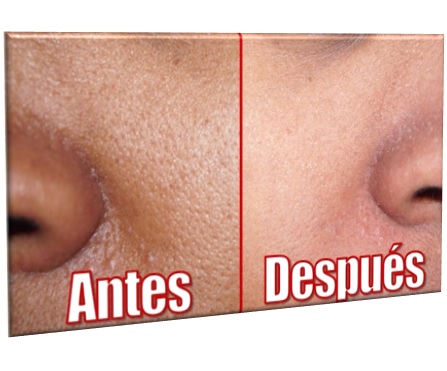 Loción rostro anti acné tónico facial espinillas astringente piel grasa