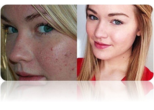Loción rostro anti acné tónico facial espinillas astringente piel grasa