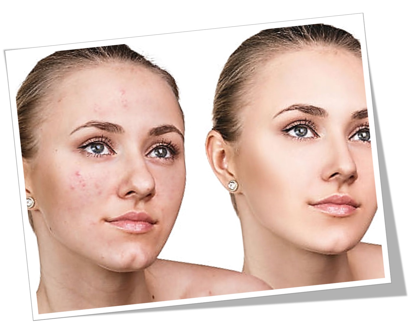 Gel purificante + Jabón piel grasa rostro control seb levinia dermik