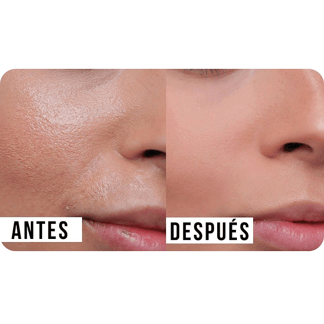 Gel limpiador facial pure skin + Loción astringente rostro antiacné set