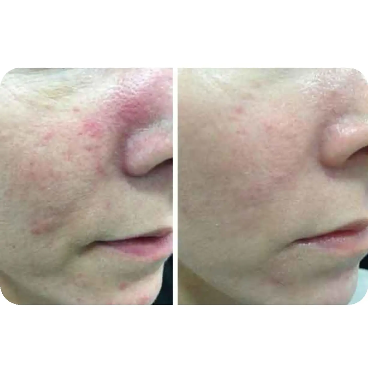 Gel descongestivo rosácea, piel enrojecida Dr Fontboté antienrojecimiento set 2 2