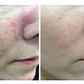 Gel descongestivo rosácea, piel enrojecida Dr Fontboté antienrojecimiento set 2 - Miniatura 2