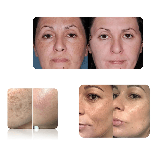 3 cremas antimanchas despigmentadora facial Dr. Fontboté