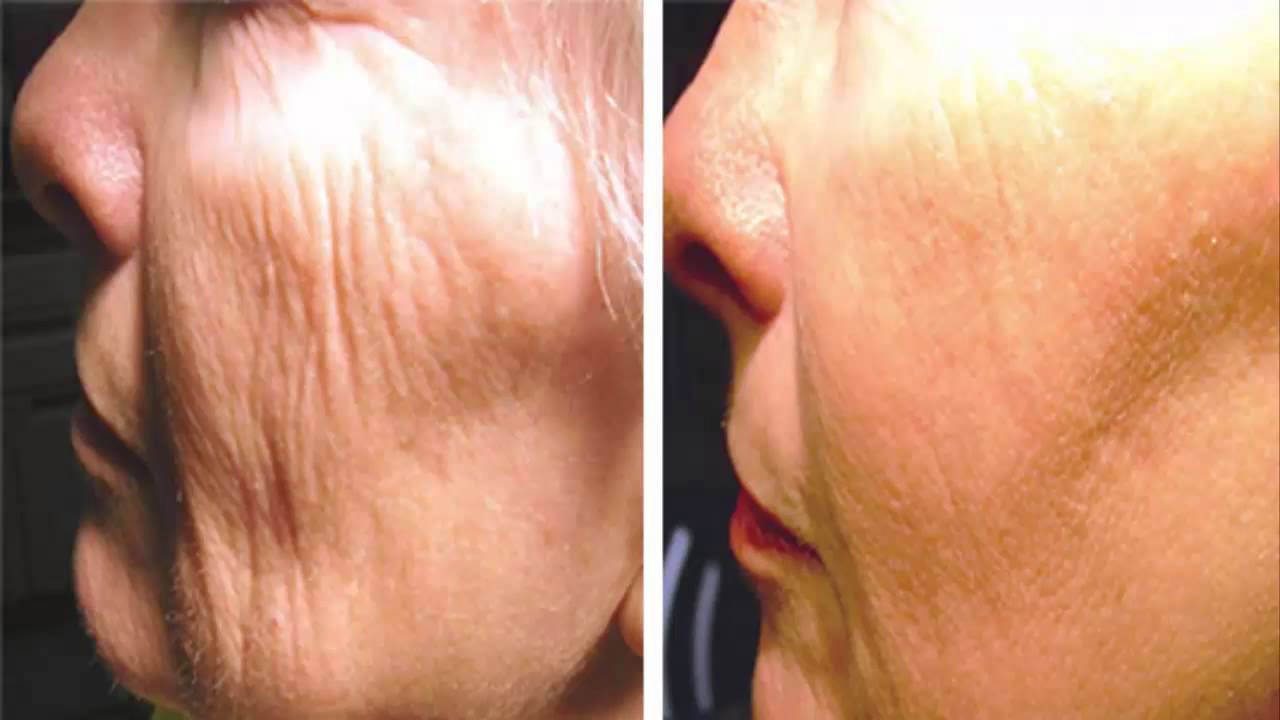 Crema facial ácido hialurónico Dr. Fontboté H.2 antiedad arrugas