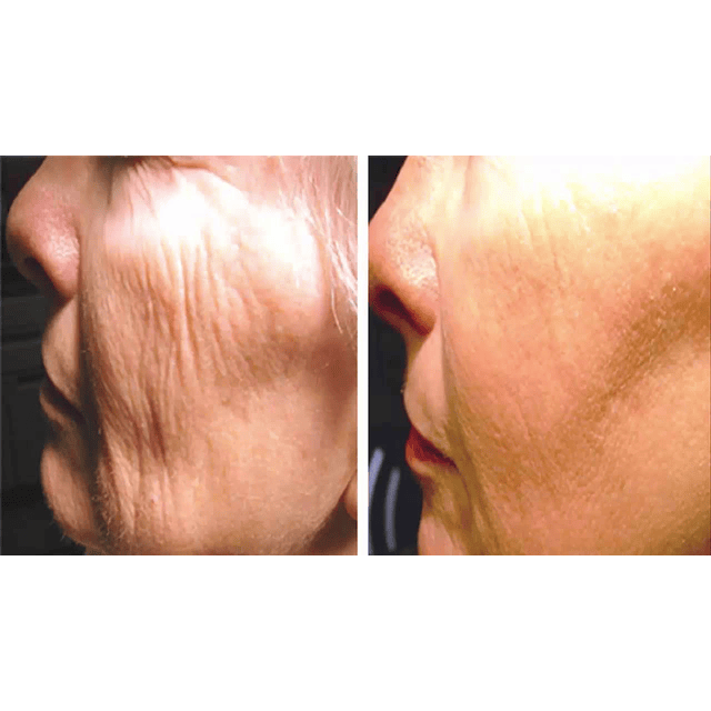 Crema facial ácido hialurónico Dr. Fontboté H.2 antiedad arrugas