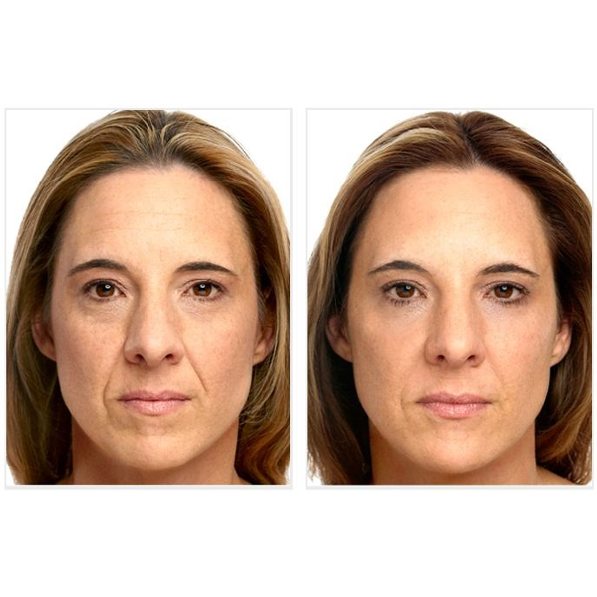 Мезоботокс это. Мезоботокс для лица. Мезоботокс лица до и после. Мезоботокс для лица фото до и после.