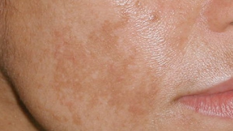 Crema blanqueadora piel manchas despigmentante eliminar melasma sol rostro