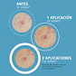 Parches Hidrocoliode SOS Imperfecciones 18 units Iroha Nature - Miniatura 5