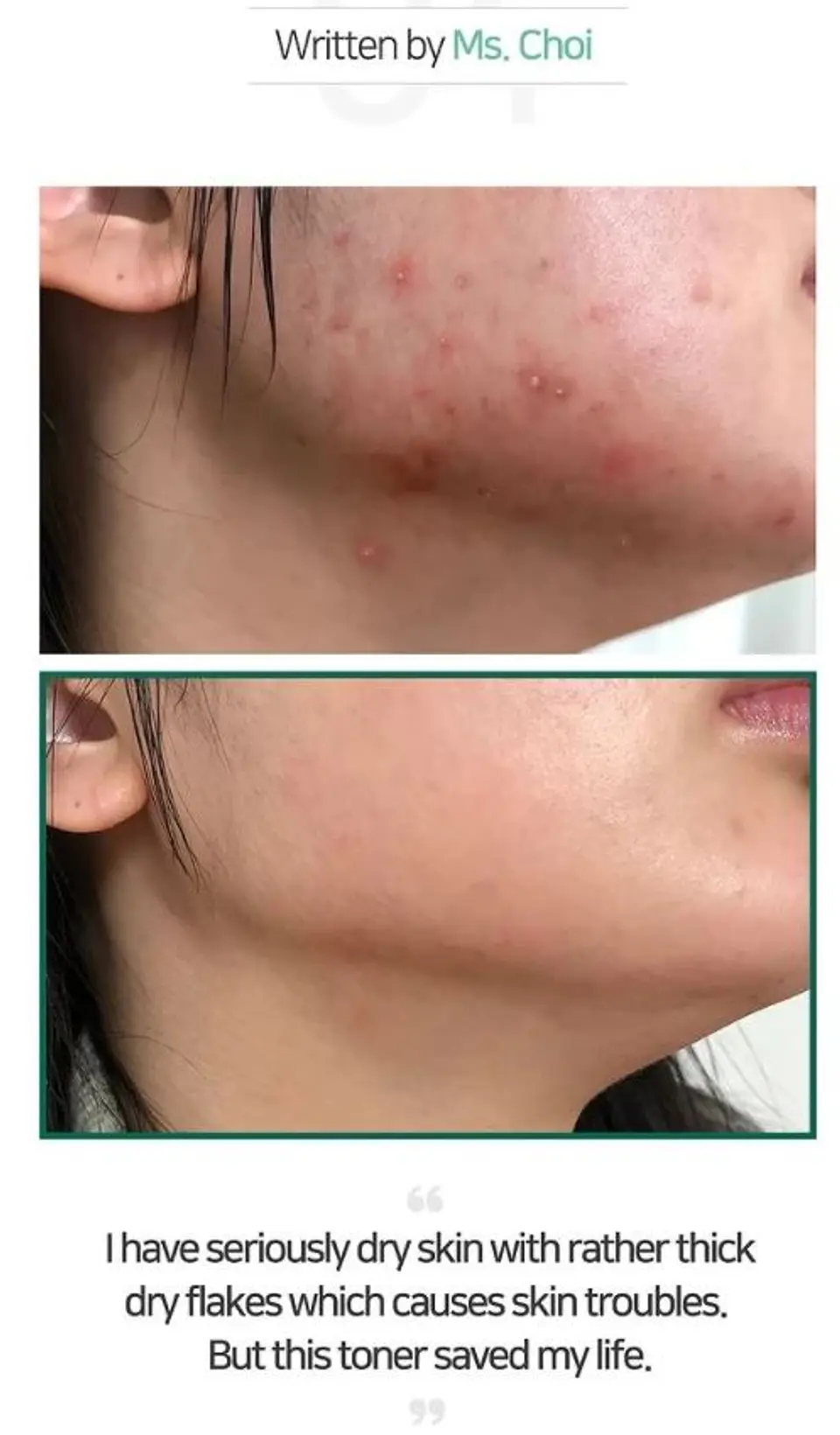 AHA BHA PHA 30 Days Miracle Toner (Some By Mi) - 150ml Tónico para pieles con problemas 3