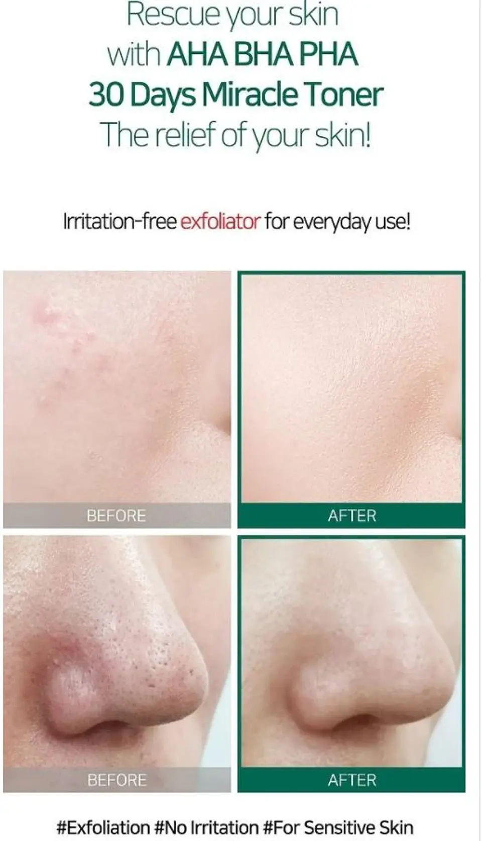 AHA BHA PHA 30 Days Miracle Toner (Some By Mi) - 150ml Tónico para pieles con problemas 7