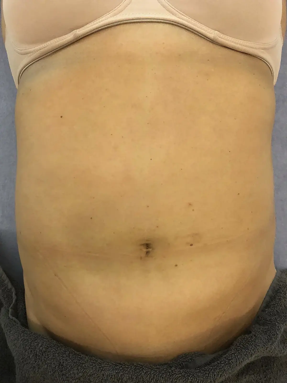 Lipo Cavitation + Radiofrequency