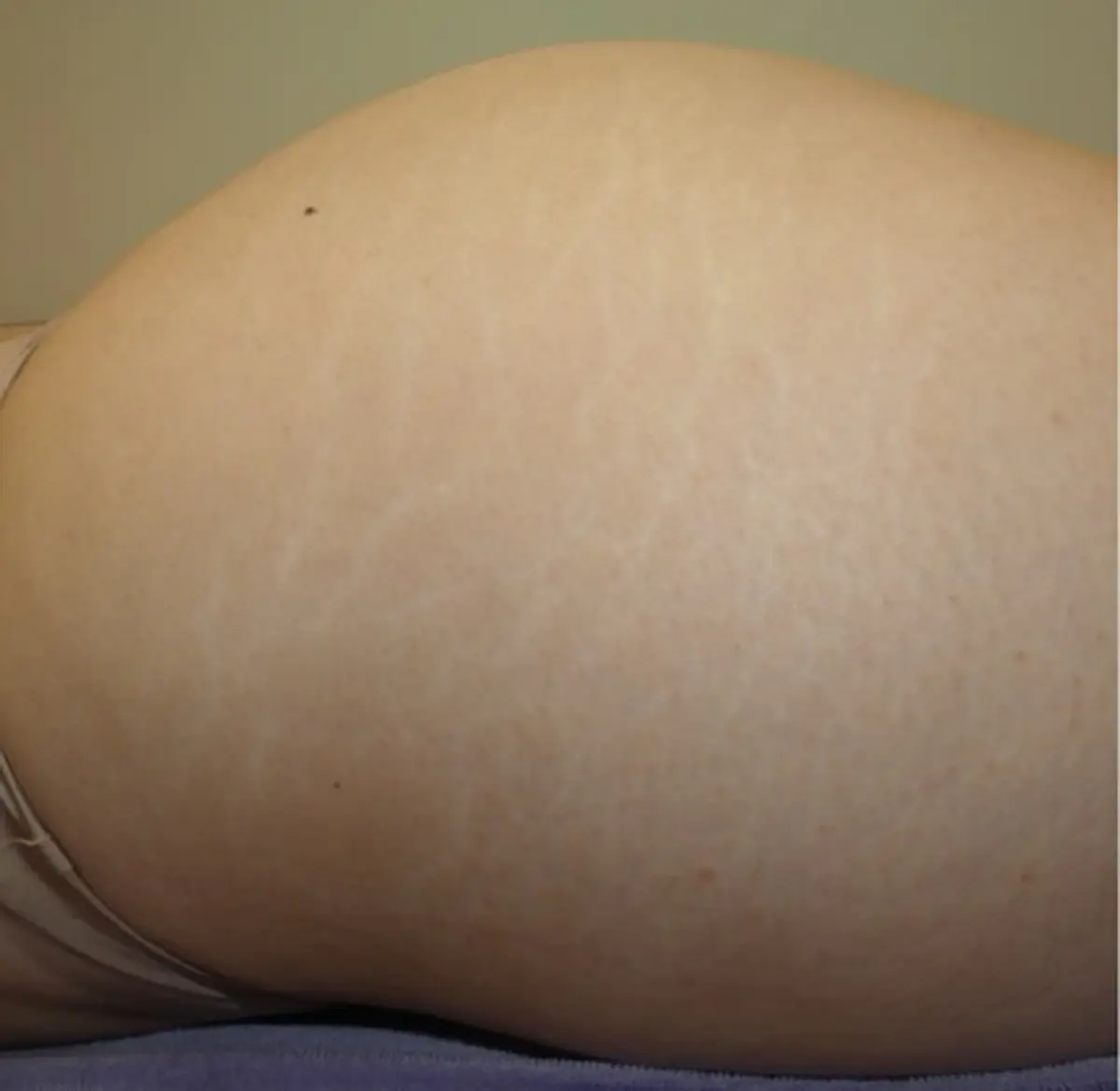 Tixel - for stretchmarks
