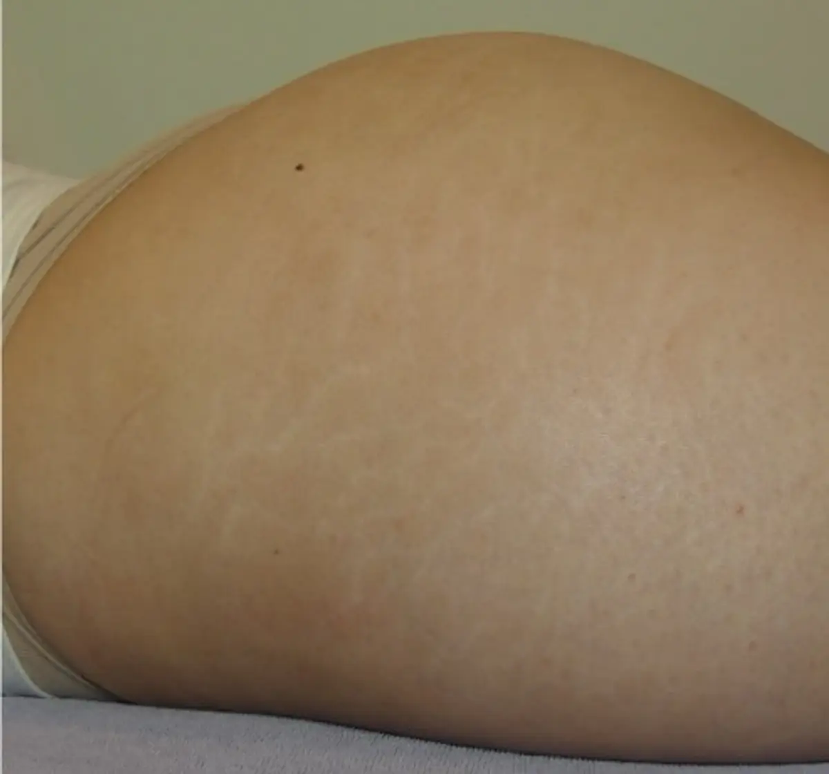 Tixel - for stretchmarks