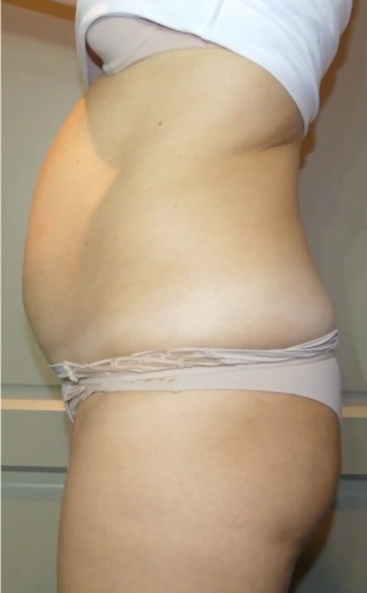 HIFU for the abdomen