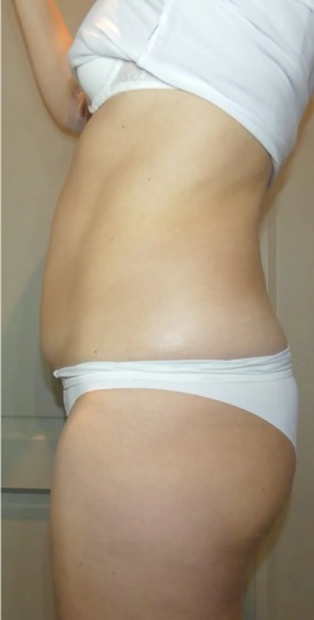 HIFU for the abdomen